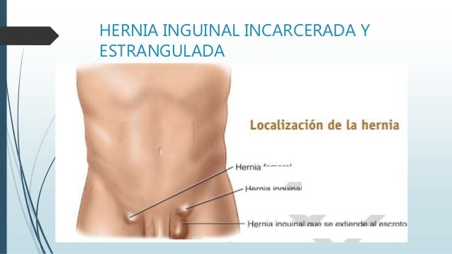hernia estrangulada